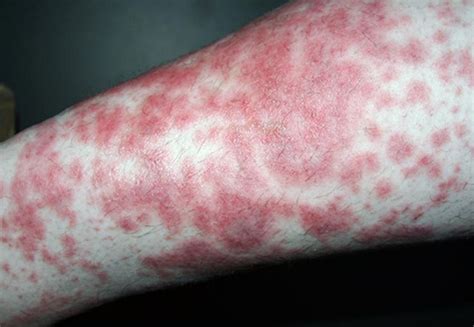 The centers of the patches can become pale with visible blood. . Diabetes skin rash photos